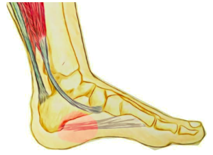 Plantar Fasciopathy Sydney Sports Physio Rehab