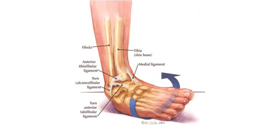 Deltoid Ligament Ankle Sprain التواء الكاحل بالرباط الدالي