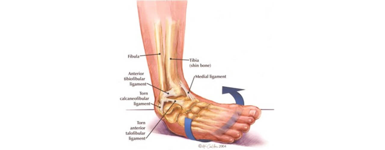 The Lower Ankle Sprain