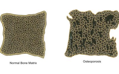 Facts About Osteoporosis