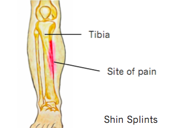 Focus On Shin Splints