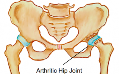 Osteoarthritis of the Hip