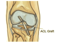 ACL Tears and Surgery