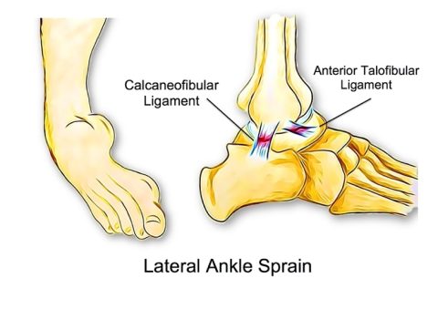 Ankle Sprains - Sydney Sports Physio & Rehab