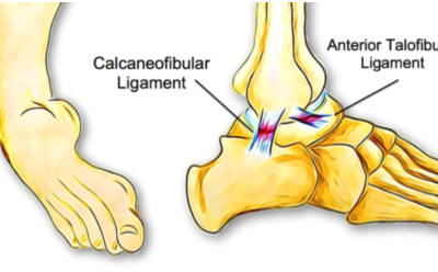What Is Chronic Ankle Instability?